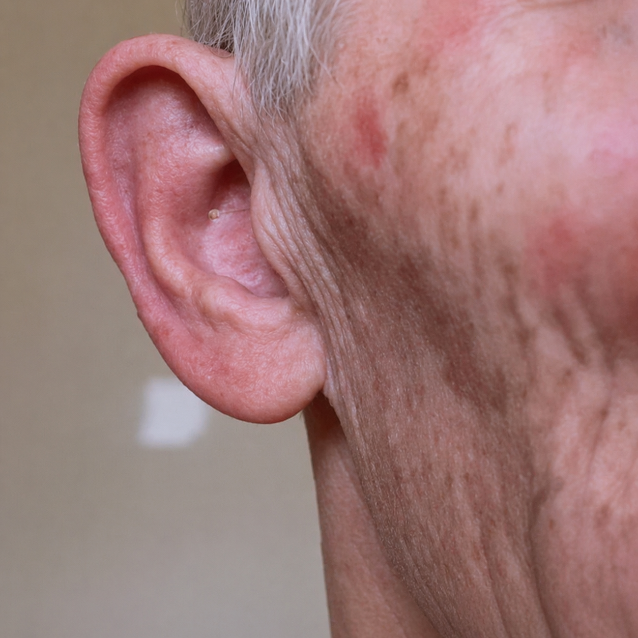 Audífono Micro CIC Paisblog colocado dentro del canal auditivo, prácticamente invisible desde fuera